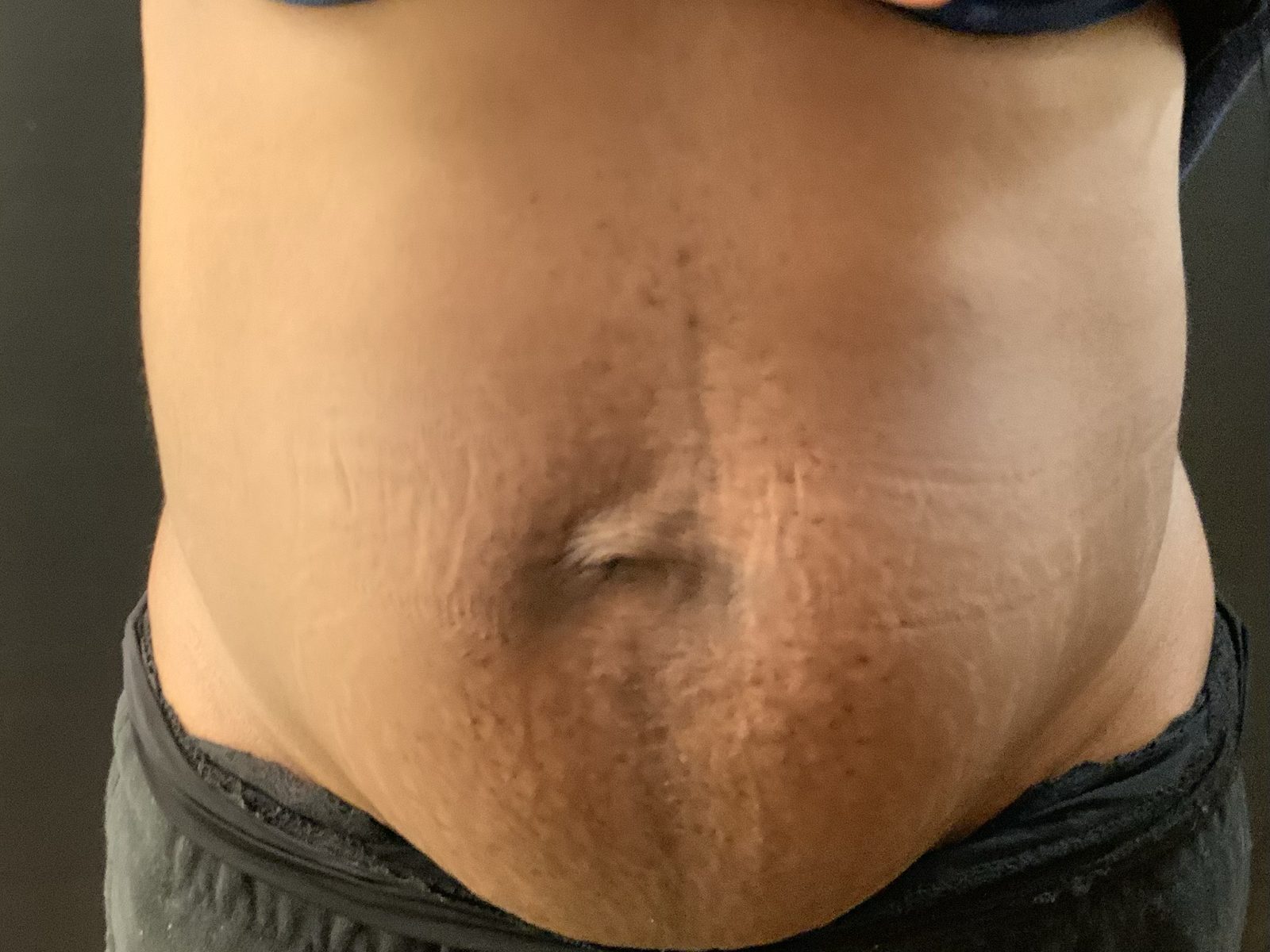 Résultat après abdominoplastie du post-partum avec réparation d'un diastasis des grands droits (photographie 1 sur 4)