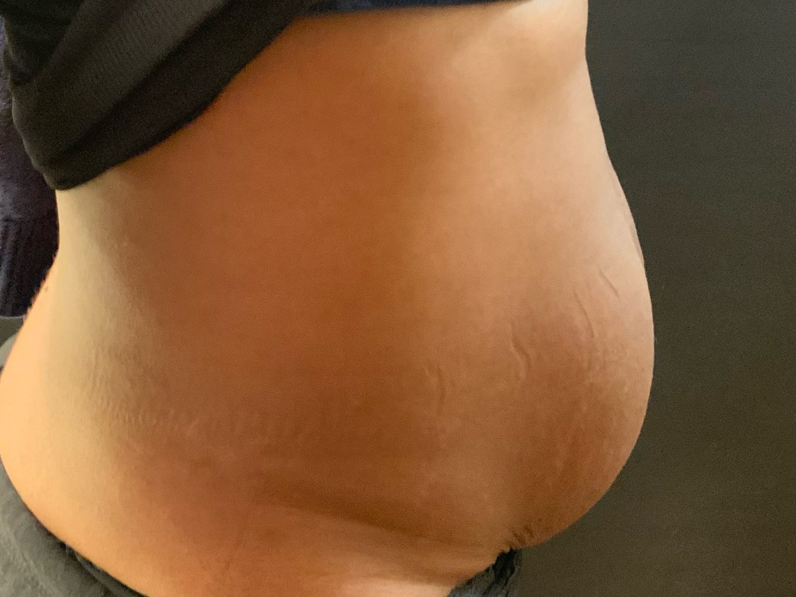 Résultat après abdominoplastie du post-partum avec réparation d'un diastasis des grands droits (photographie 2 sur 4)