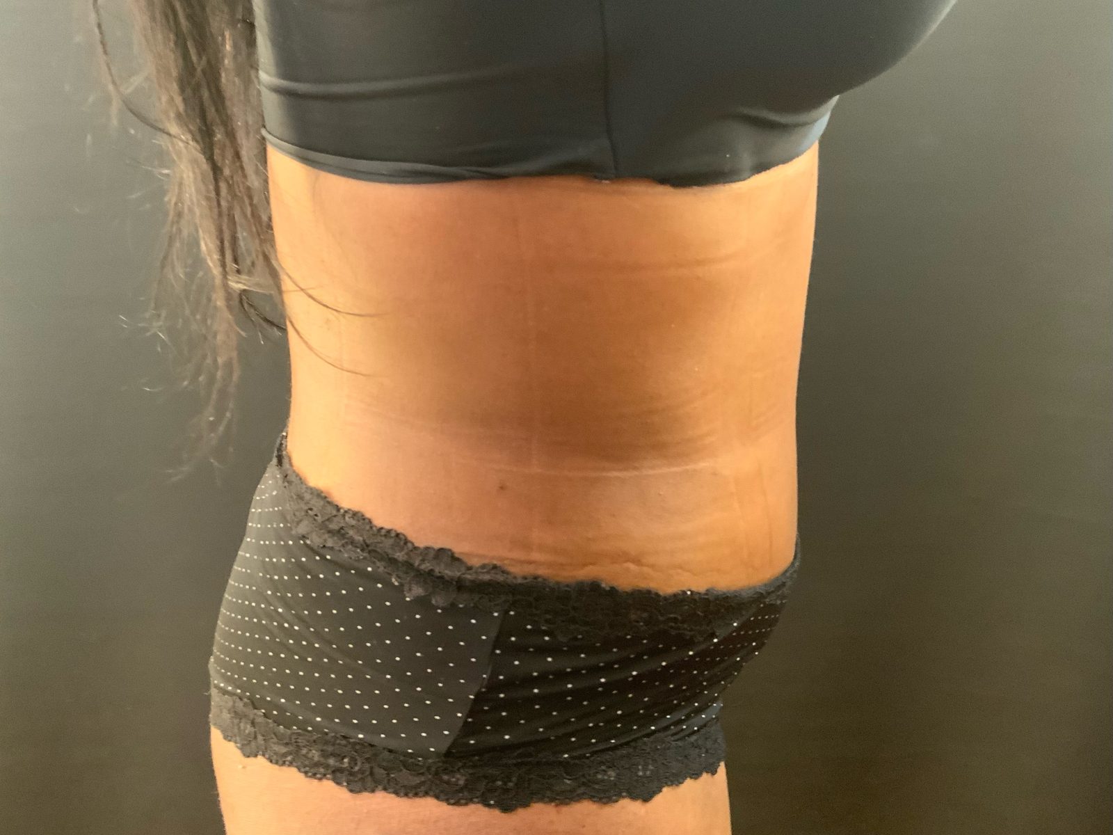 Résultat après abdominoplastie du post-partum avec réparation d'un diastasis des grands droits (photographie 4 sur 4)