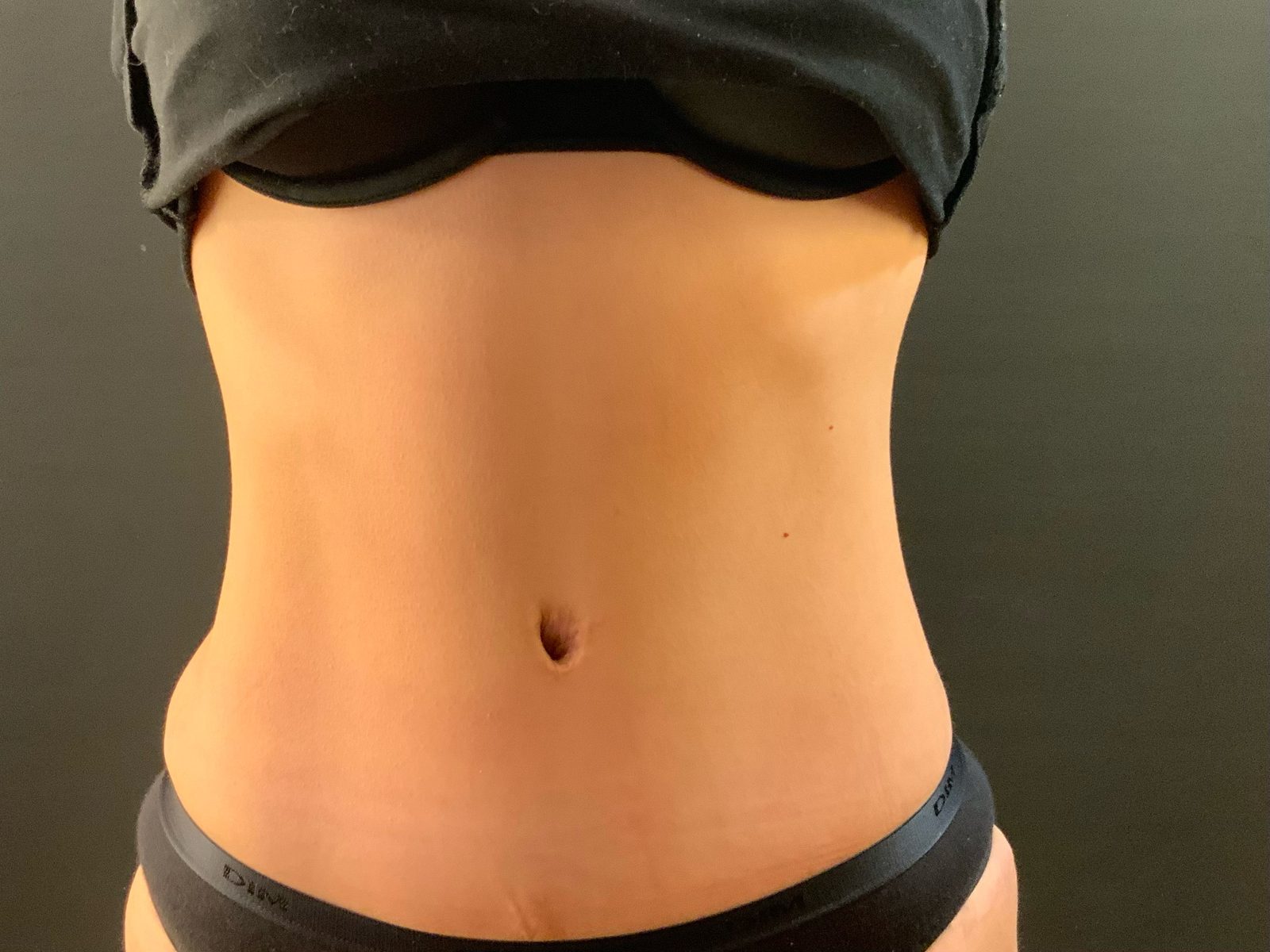 Résultat d'abdominoplastie puis évolution de la silhouette après reprise progressive du sport (photographie 5 sur 6)
