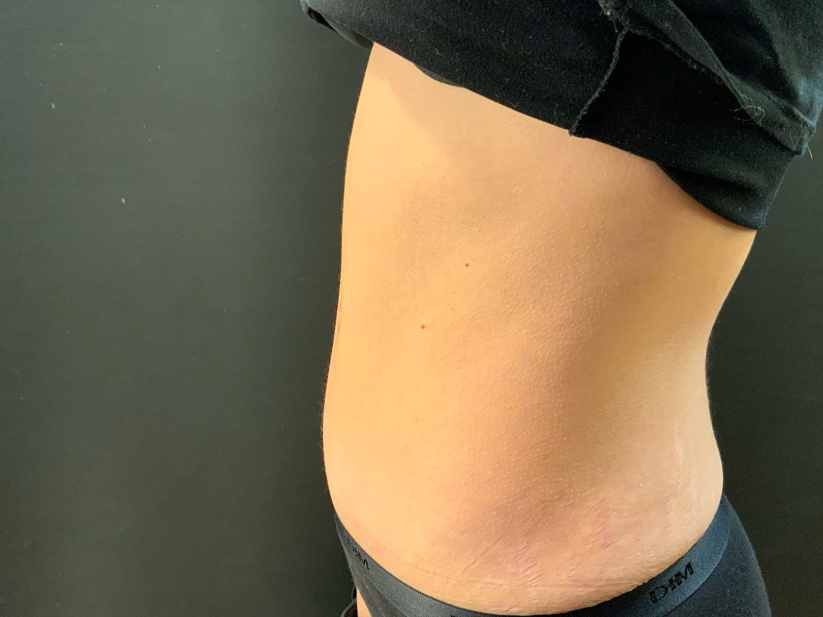 Résultat d'abdominoplastie puis évolution de la silhouette après reprise progressive du sport (photographie 6 sur 6)