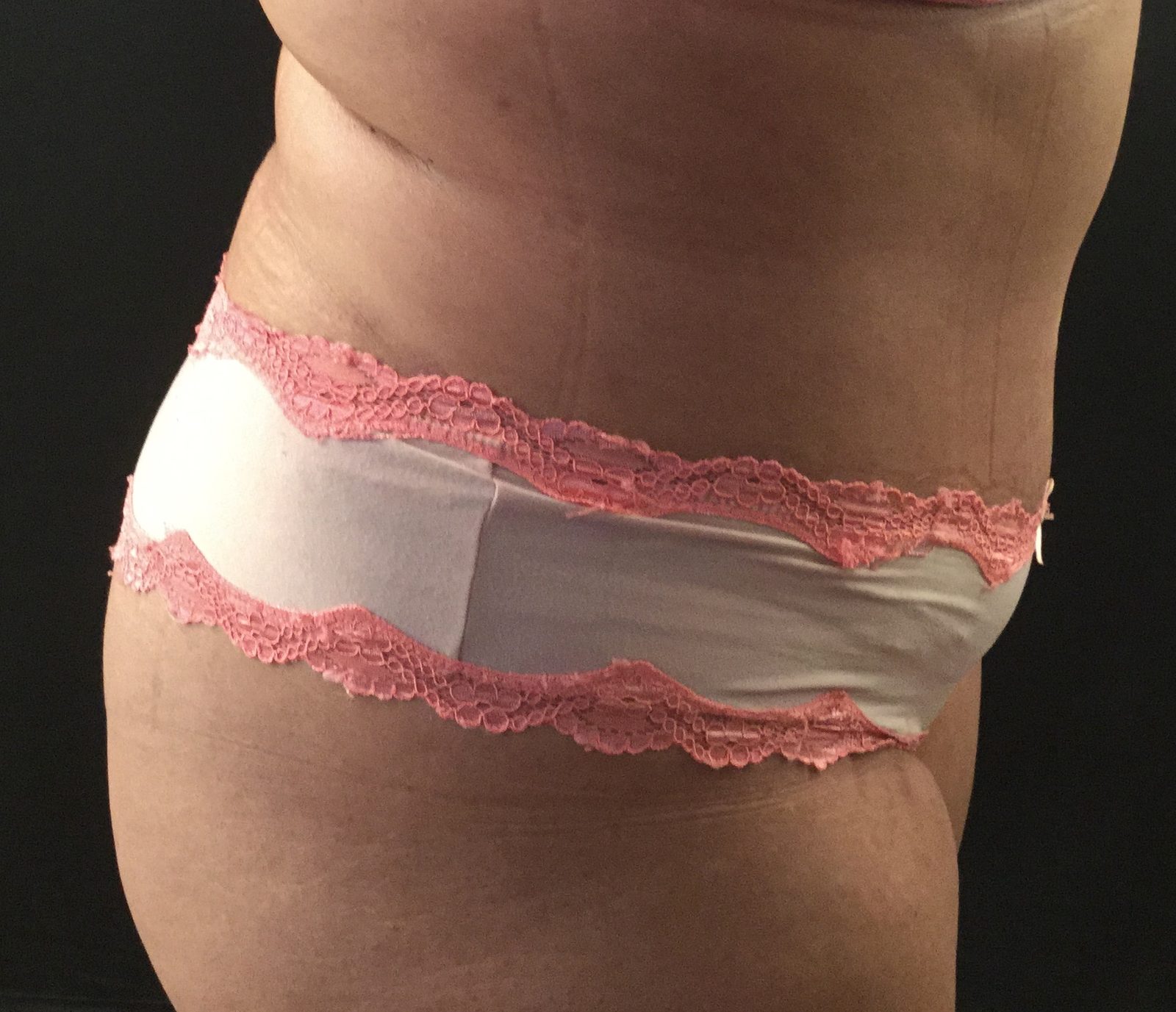 Photographie clinique d'un ventre post-partum avec excès cutané et distension de la paroi (photographie 3 sur 3)