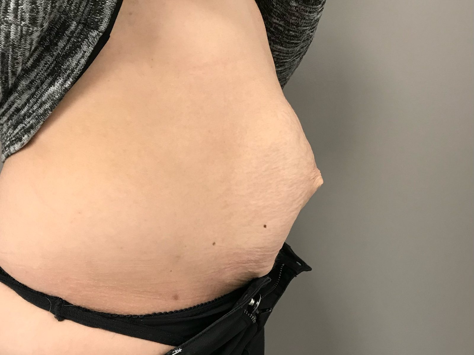 Photographie clinique de la paroi abdominale après grossesse (photographie 2 sur 4)