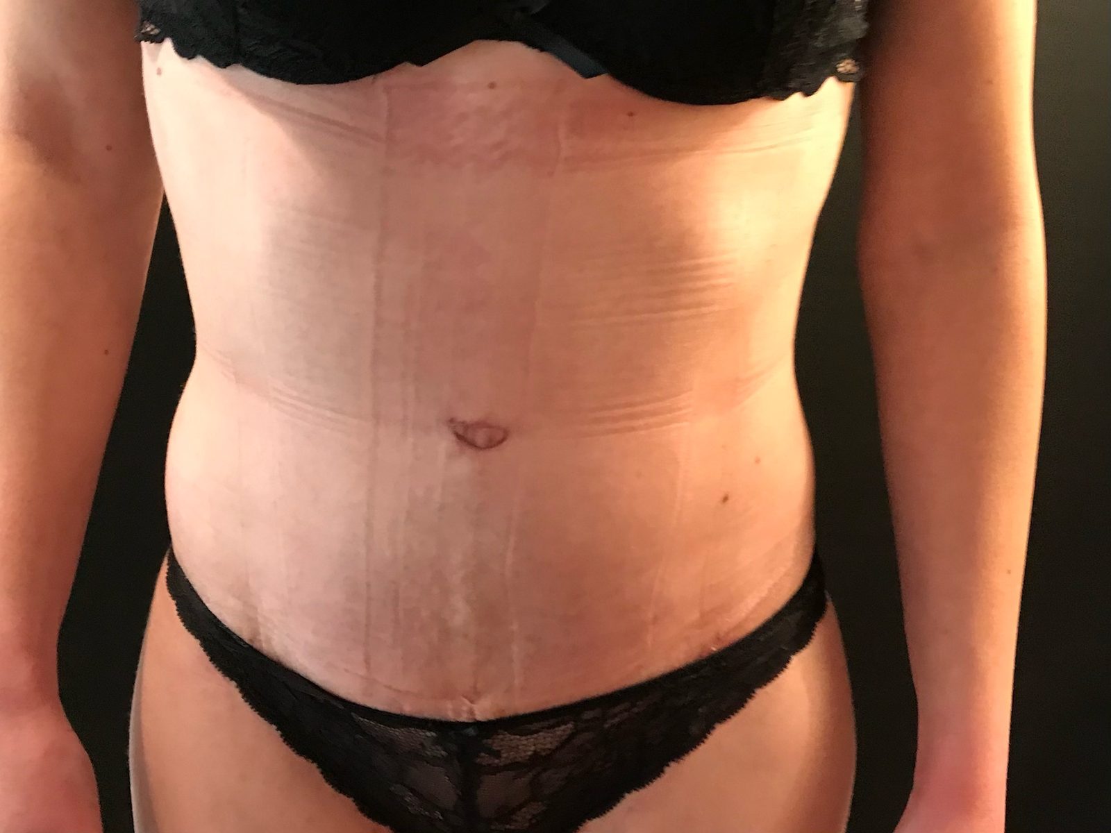 Photographie clinique de la paroi abdominale après grossesse (photographie 3 sur 4)