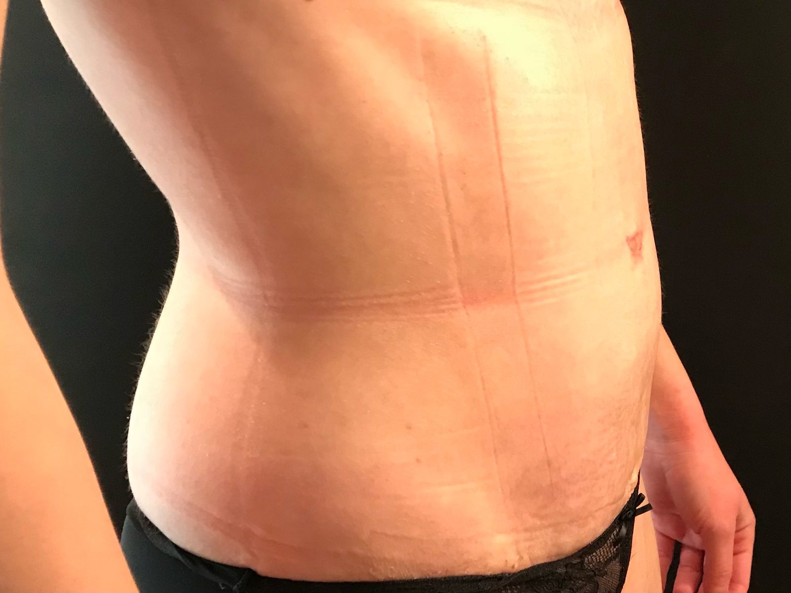 Photographie clinique de la paroi abdominale après grossesse (photographie 4 sur 4)