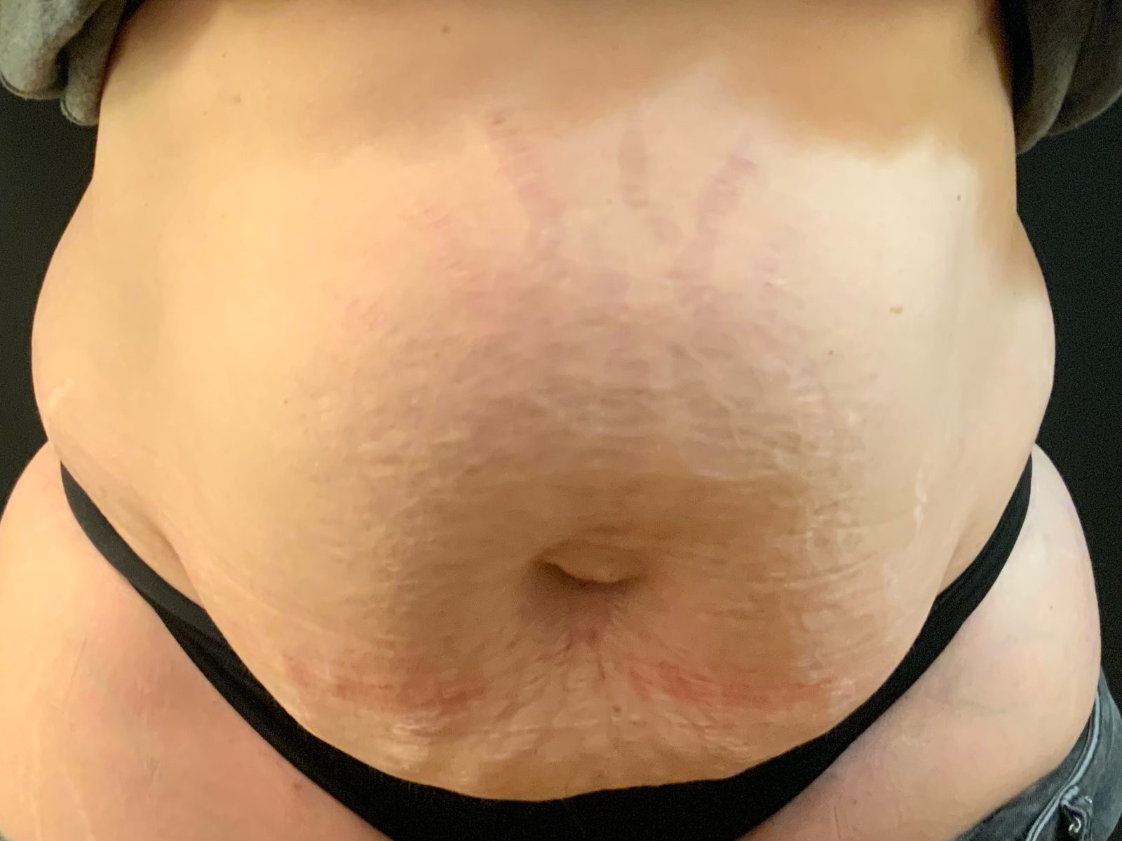 Photographie clinique d'un diastasis des muscles grands droits après grossesse (photographie 1 sur 2)