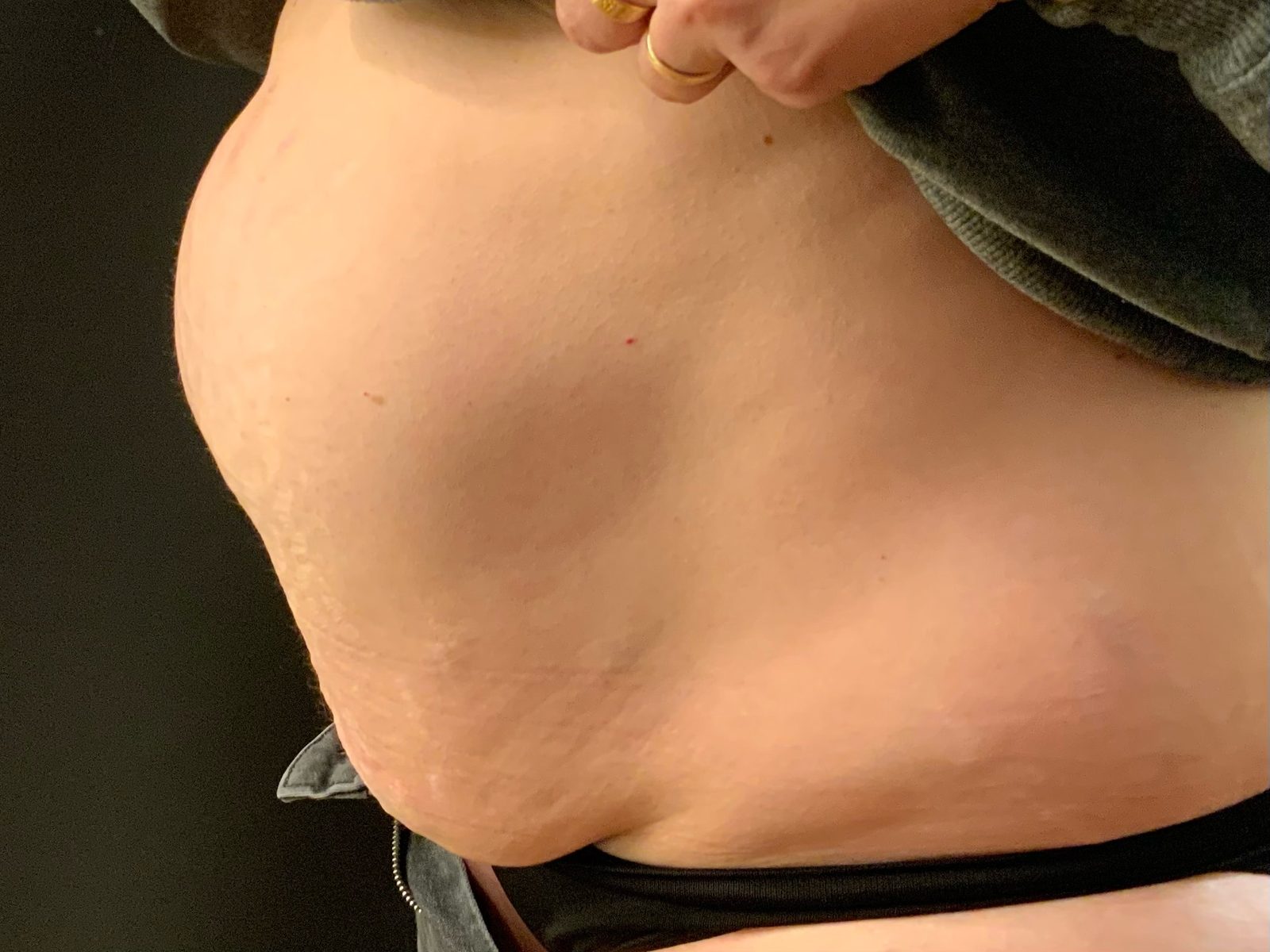 Ventre bombé après grossesse avec suspicion de diastasis des grands droits.