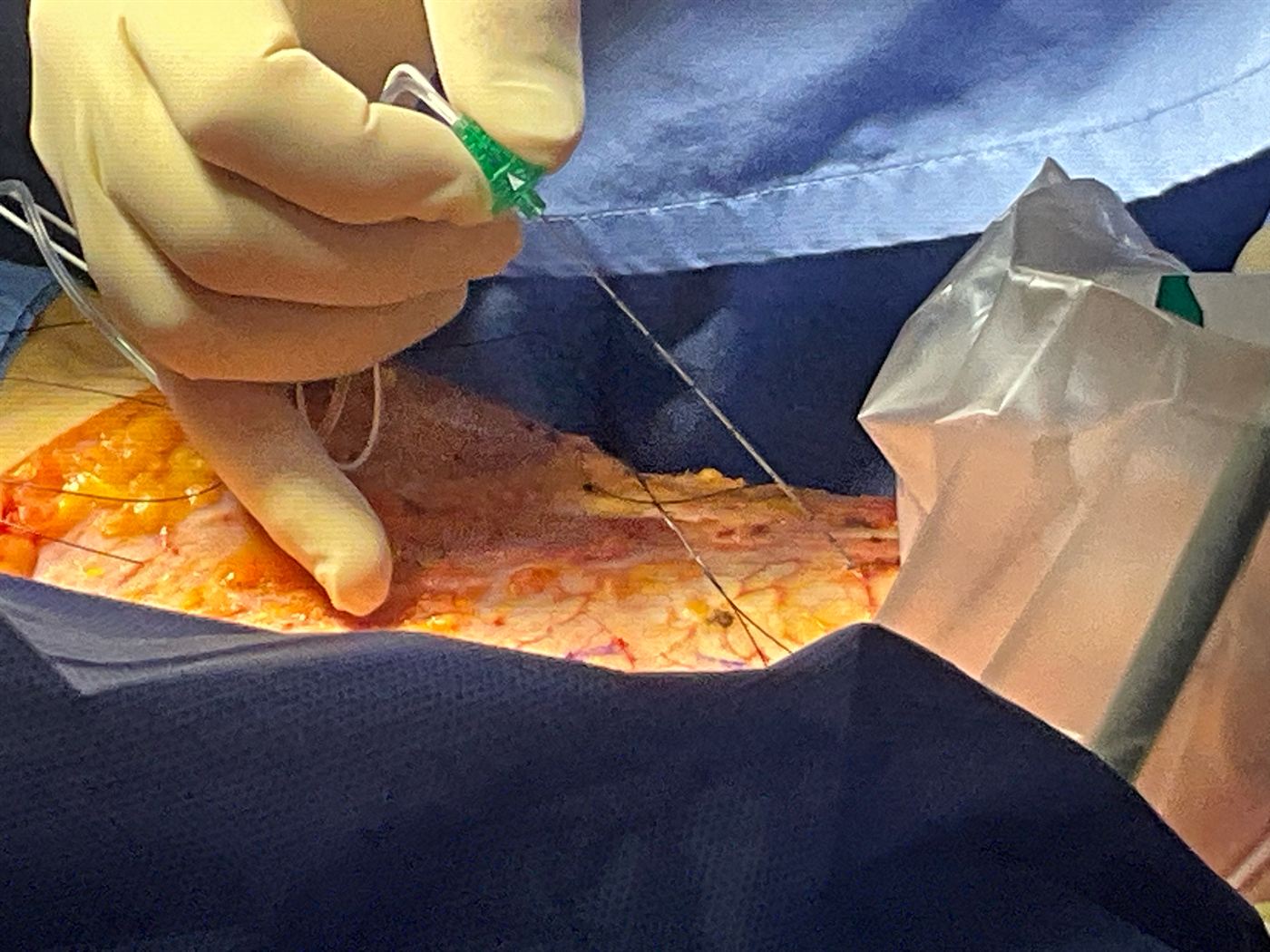 Injection de l'anesthésique local au contact de la gaine du muscle droit de l'abdomen, sous contrôle échographique.
