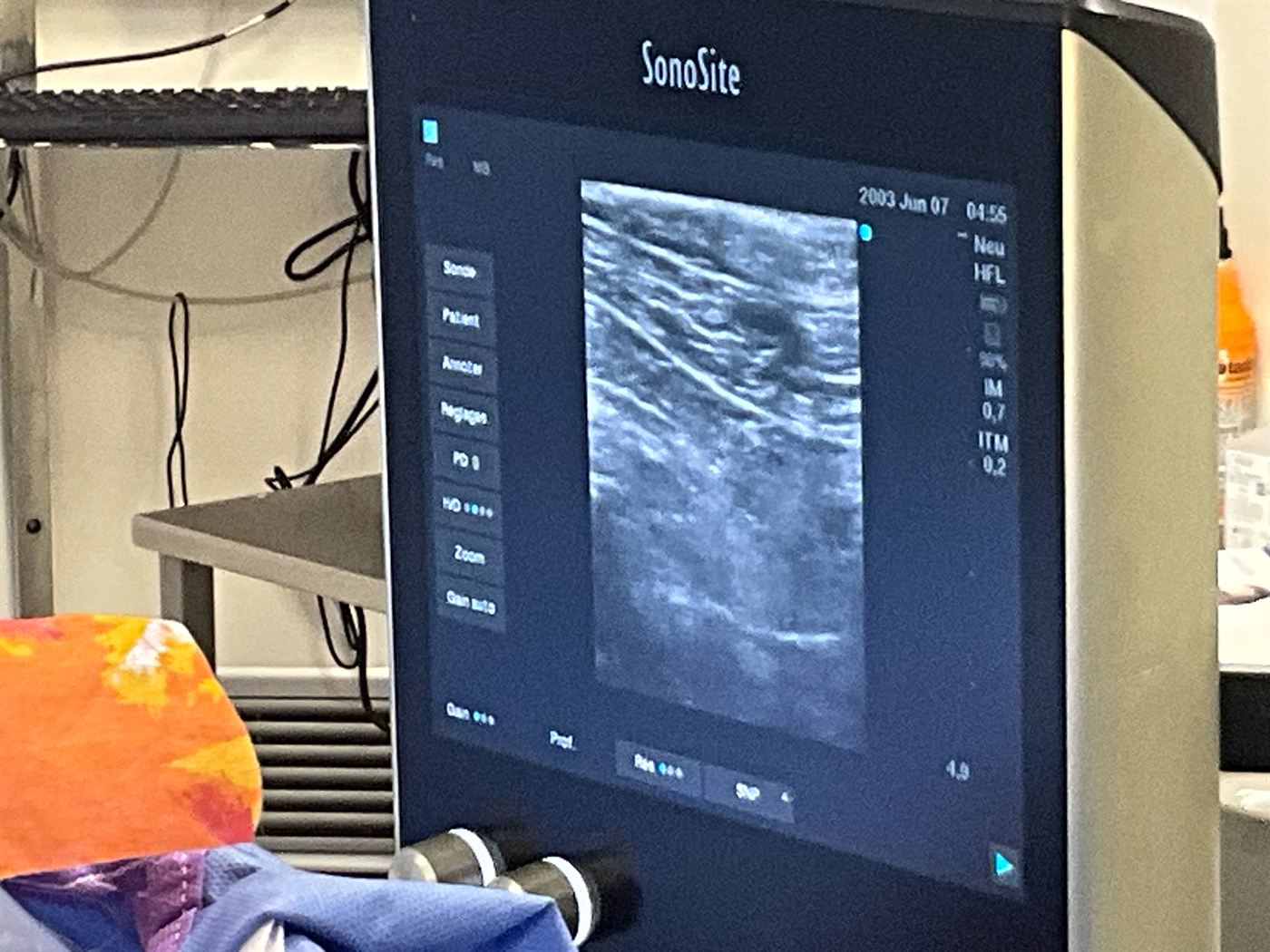 Écran d'échographe SonoSite montrant le guidage échographique du Rectus Block, avec la visualisation des plans musculaires de la paroi abdominale.